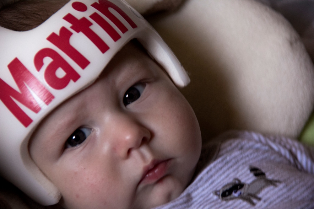 Martin Williams wears a DOC Band that helps shape his head to a normal shape. He has a cranial condition called Plagiocephaly and he has to wear the band 23 hours a day. (Photo by Alexis Macklin)