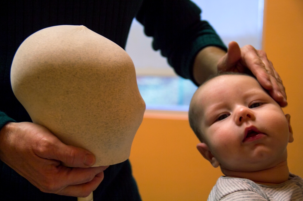 Dr. Mary Johnson examines Martin Williams’ head at his weekly check up on Nov. 4, 2014 at Phoenix Children’s Hospital in Phoenix. The dummy head is a replica of his head when he was born.  (Photo by Alexis Macklin)